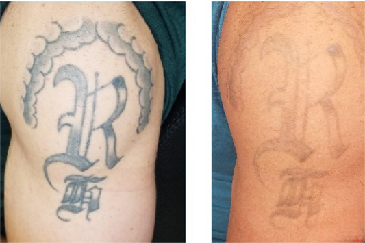 Tattoo Removal: A Comprehensive Guide to Safe and Effective Tattoo Removal