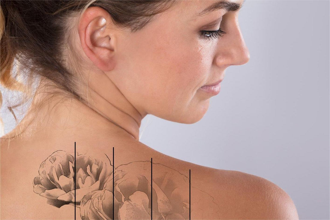 Say Goodbye to Unwanted Ink NEATCELL Picosecond Laser Tattoo Removal