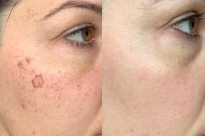 Spot Removal: Achieve Spotless Skin in One Session