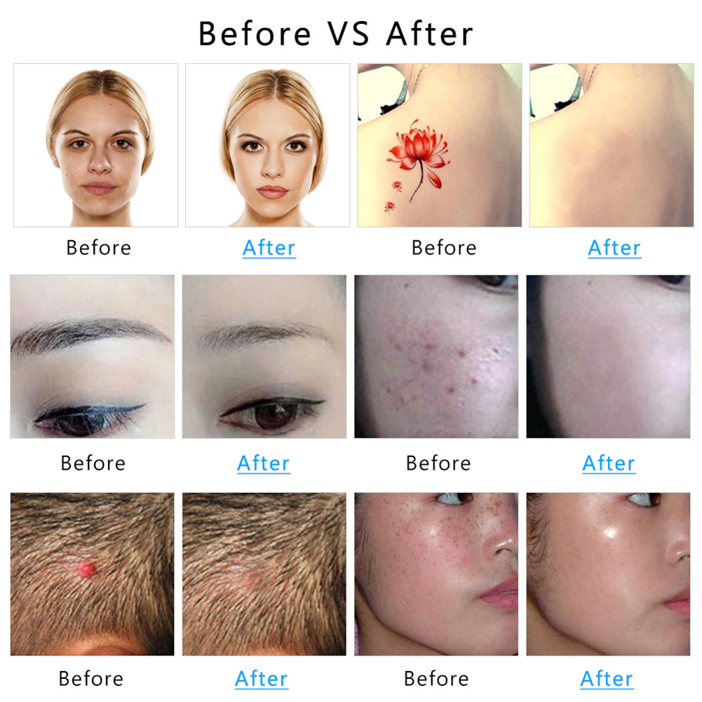 Cosmetic Tattoo Removal & Lightening – Skincare Laser Clinic