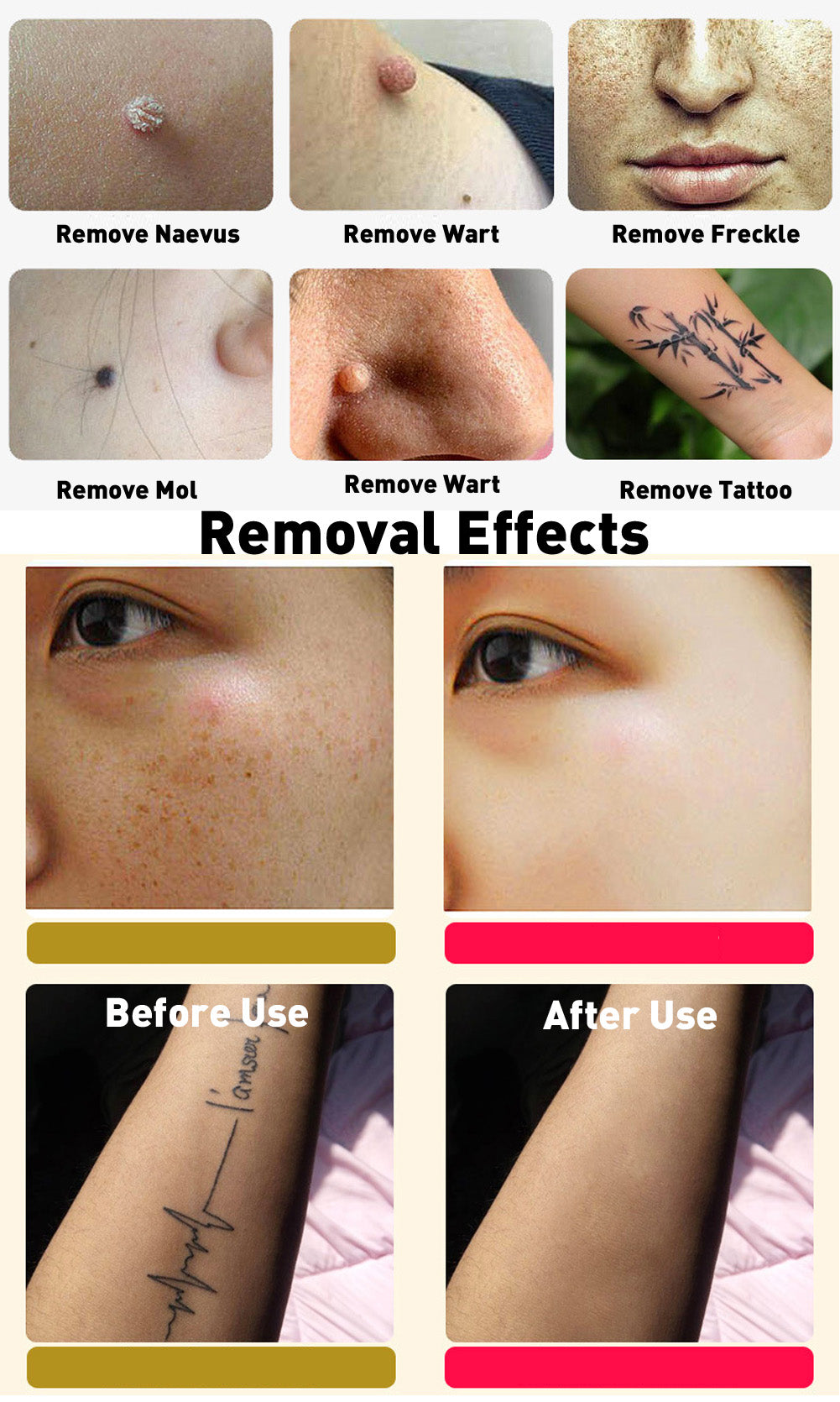 Prague Laser Freckle Mole Removal Pen Device Face Skin Tattoos, Dark Spot  Remover Price in India - Buy Prague Laser Freckle Mole Removal Pen Device  Face Skin Tattoos, Dark Spot Remover online